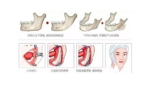 南京磨骨瘦脸医院排名