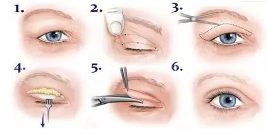 郑大二附院整形科割双眼皮