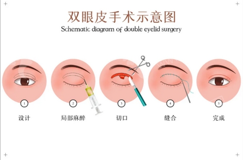 川北医学院双眼皮费用