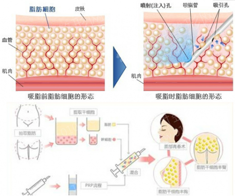 深圳北大热玛吉费用