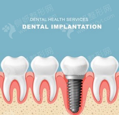 上海英博口腔门诊种植牙好不好