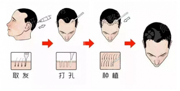 北大医院植发科