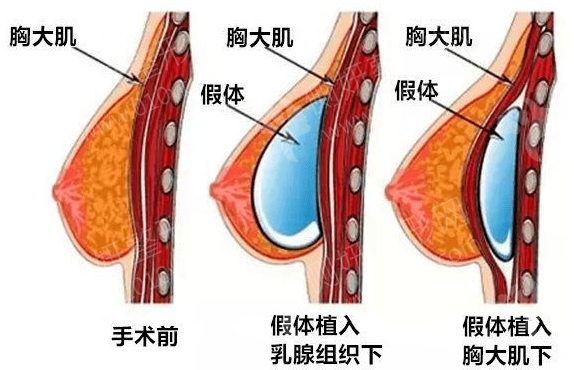 郑大一附院假体隆胸