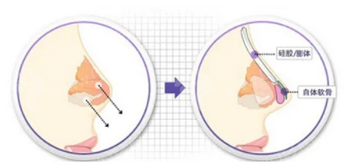 深圳北大医院硅胶隆鼻