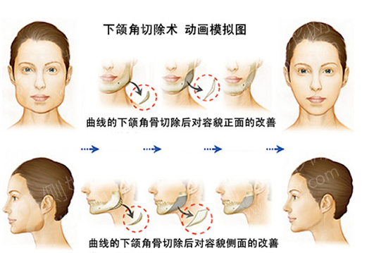 上海美联臣颌面整形科面部整形