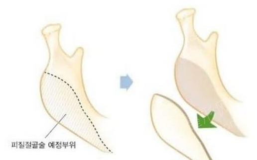 上海磨骨整形医院磨颧骨