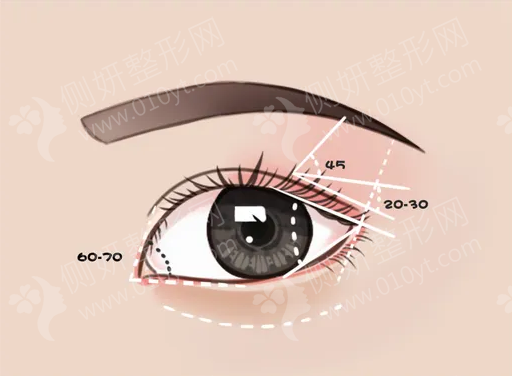 广州医学院第三附属医院整形科全切双眼皮