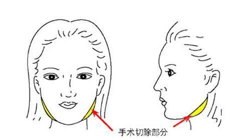 山东省立医院下颌角手术