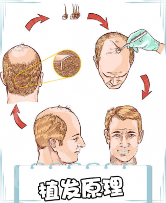衡阳华美整形医院植发科无痕植发