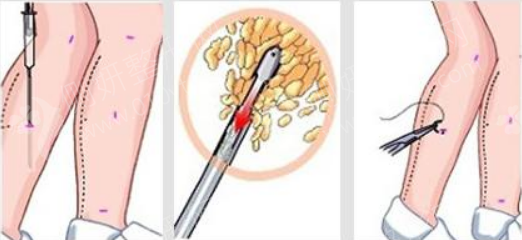 哈医大医院小腿吸脂