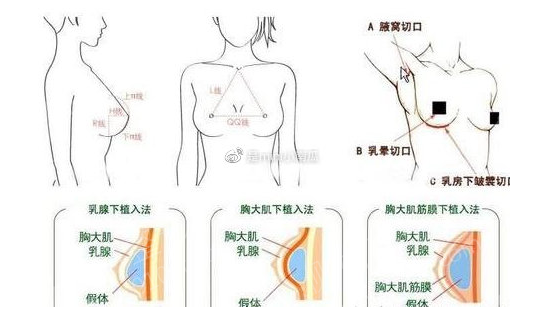 怀化市第一人民医院整形外科硅胶隆胸