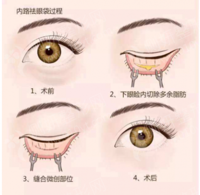 衢州市人民医院整形科韩式双眼皮