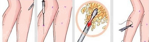 广州南方医院腿部抽脂