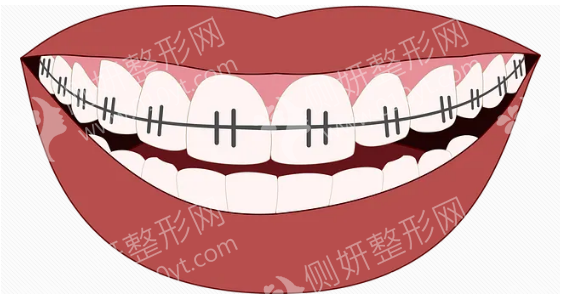 衡阳169医院口腔科牙齿矫正